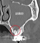 歯性上顎洞炎、歯性副鼻腔炎のCT